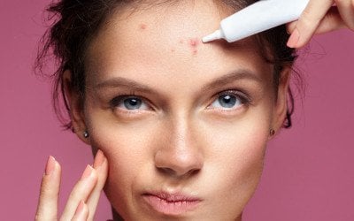 behandeling acne